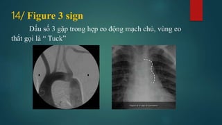 Signs in chest xray | PPTX