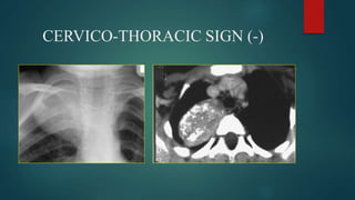 Stuart Sign Cervical Signs in chest xray | PPTX