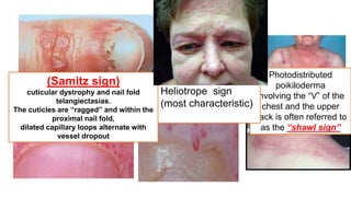 Samitz Sign Signs in dermatology.pptx