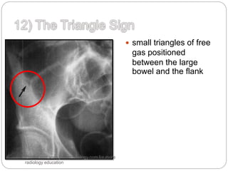  small triangles of free
gas positioned
between the large
bowel and the flank
Please visit www.jssmcradiology.com for more
radiology education
 