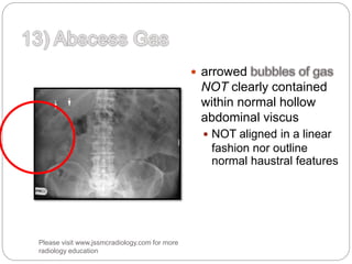  arrowed
NOT clearly contained
within normal hollow
abdominal viscus
 NOT aligned in a linear
fashion nor outline
normal haustral features
Please visit www.jssmcradiology.com for more
radiology education
 