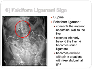  Supine
 Falciform ligament
 connects the anterior
abdominal wall to the
liver
 extends inferiorly
beyond the liver →
becomes round
ligament
 becomes
in a patient
with free abdominal
gasPlease visit www.jssmcradiology.com for more
radiology education
 