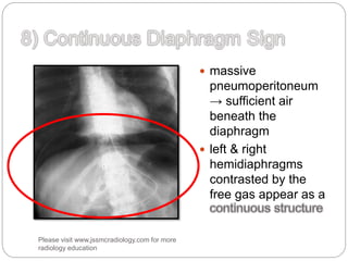  massive
pneumoperitoneum
→ sufficient air
beneath the
diaphragm
 left & right
hemidiaphragms
contrasted by the
free gas appear as a
Please visit www.jssmcradiology.com for more
radiology education
 