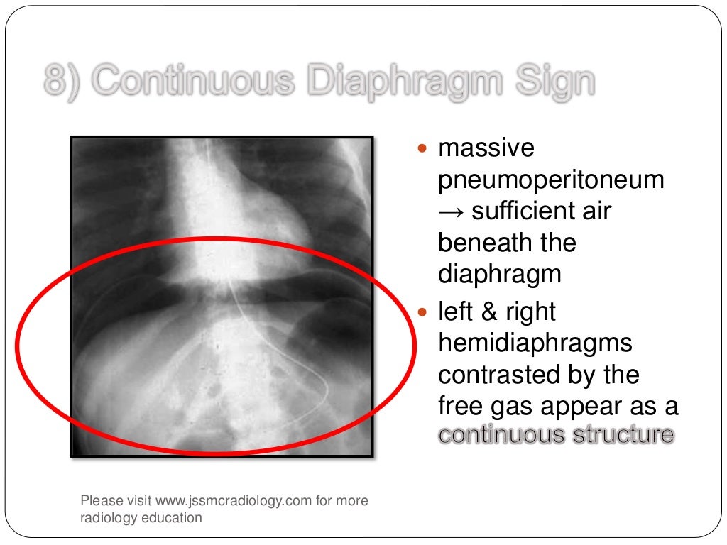 Signs in pneumoperitoneum