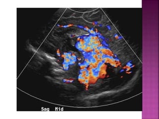 Signs in radiology | PPTX