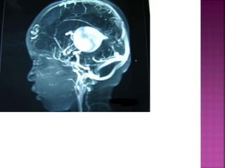 Bitr Sign Radiology Signs in radiology | PPTX