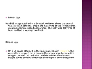 Signs in radiology | PPTX