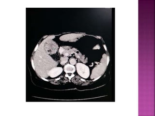 Signs in radiology | PPTX