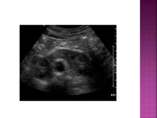 Bitr Sign Radiology Signs in radiology | PPTX