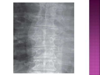 String. Sign Vertebral Signs in radiology | PPTX