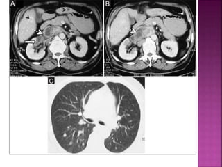 Bitr Sign Radiology Signs in radiology | PPTX