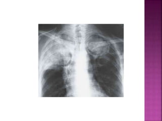 Bitr Sign Radiology Signs in radiology | PPTX