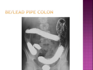 Signs in radiology | PPTX