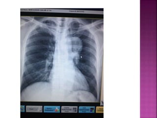 Signs in radiology | PPTX