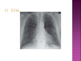 Bitr Sign Radiology Signs in radiology | PPTX