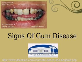 Signs Of Gum Disease
http://www.drkezian.com/cosmetic-dentist-los-angeles.php
 