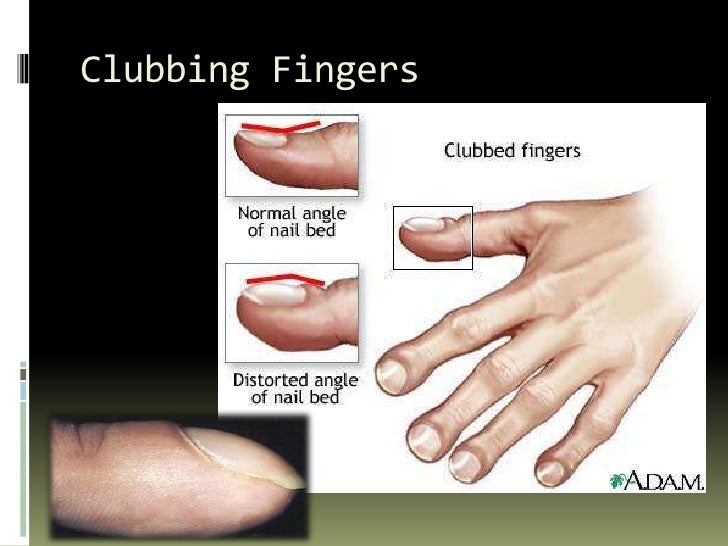 Signs of liver diseases