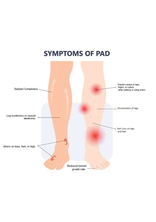 Signs of Peripheral Artery Disease | USA Vascular Centers