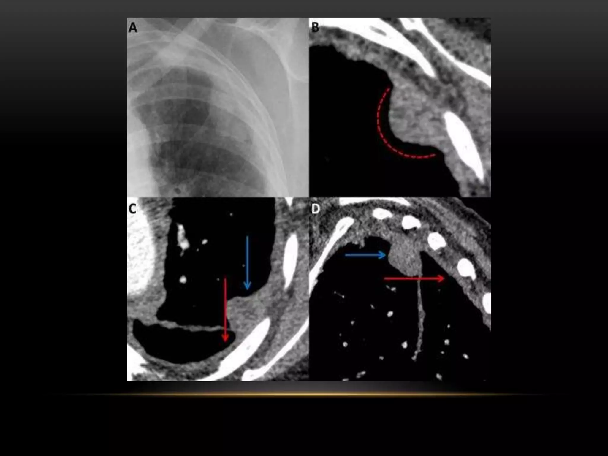 Signs of radiological importance in the thorax Dr.Sumit Sharma | PPTX