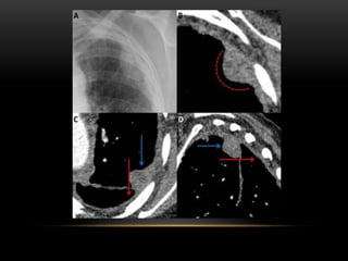 Triangular Sign Chest Signs of radiological importance in the thorax Dr.Sumit Sharma | PPTX