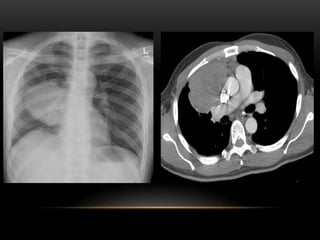 Signs of radiological importance in the thorax Dr.Sumit Sharma | PPTX