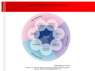 Different manifestations of myocardial ischaemia
Ferrari, R. et al. (2017) A ‘diamond’ approach to personalized treatment of angina
Nat. Rev. Cardiol. doi:10.1038/nrcardio.2017.131
 
