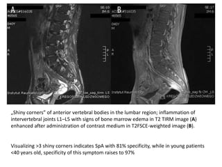 „Shiny corners” of anterior vertebral bodies in the lumbar region; inflammation of
intervertebral joints L1–L5 with signs of bone marrow edema in T2 TIRM image (A)
enhanced after administration of contrast medium in T2FSCE-weighted image (B).
Visualizing >3 shiny corners indicates SpA with 81% specificity, while in young patients
<40 years old, specificity of this symptom raises to 97%
 