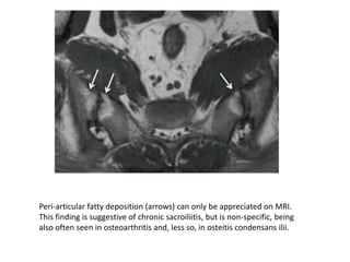 Peri-articular fatty deposition (arrows) can only be appreciated on MRI.
This finding is suggestive of chronic sacroiliitis, but is non-specific, being
also often seen in osteoarthritis and, less so, in osteitis condensans ilii.
 
