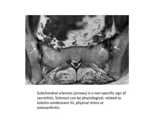 Subchondral sclerosis (arrows) is a non-specific sign of
sacroiliitis. Sclerosis can be physiological, related to
osteitis condensans ilii, physical stress or
osteoarthritis.
 