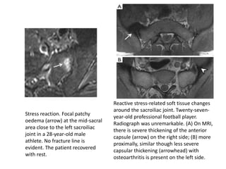 Stress reaction. Focal patchy
oedema (arrow) at the mid-sacral
area close to the left sacroiliac
joint in a 28-year-old male
athlete. No fracture line is
evident. The patient recovered
with rest.
Reactive stress-related soft tissue changes
around the sacroiliac joint. Twenty-seven-
year-old professional football player.
Radiograph was unremarkable. (A) On MRI,
there is severe thickening of the anterior
capsule (arrow) on the right side; (B) more
proximally, similar though less severe
capsular thickening (arrowhead) with
osteoarthritis is present on the left side.
 