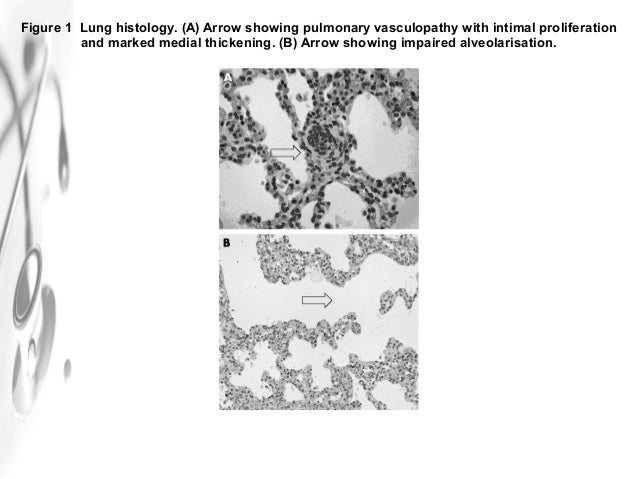 treatment of pulmonary hypertension with sildenafil treatment of pulmonary hypertension with sildenafil