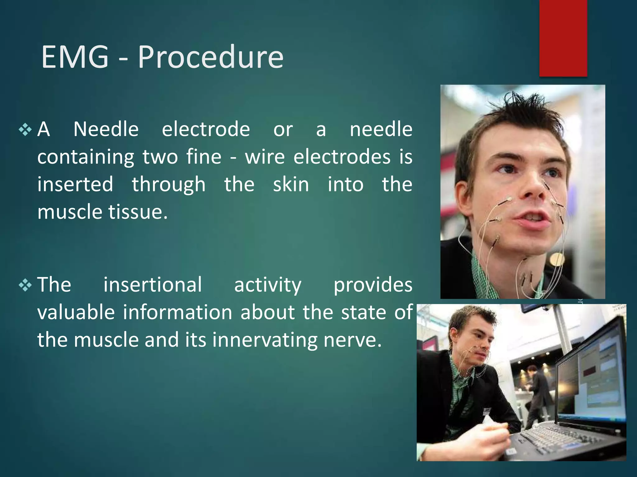 EMG - Procedure
 A Needle electrode or a needle
containing two fine - wire electrodes is
inserted through the skin into the
muscle tissue.
 The insertional activity provides
valuable information about the state of
the muscle and its innervating nerve.
 
