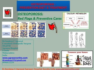 Dr.Sandeep C Agrawal Agrasen Hospital Gondia India www.agrasenortho.com!
1
1
OSTEOPOROSIS :!
PREVENTION,DIET & TREATMENT
Dr.Sandeep C Agrawal
Consultant Orthopedic Surgeon
MS,DNB
Agrasen Hospital
Gondia
Maharashtra
India
www.agrasenortho.com
drsandeep123@gmail.com
09960122234
OSTEOPOROSIS:
Red Flags & Preventive Cares
 