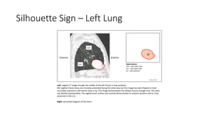 Silhouette Sign – Left Lung
Posterior Anterior
Abbreviations
LUL – Left upper lobe
LLL – Left lower lobe
LV – Left ventricle
Left: sagittal CT image through the middle of the left thorax in lung windows.
NB: Sagittal thorax views are normally presented facing the other way but this image has been flipped to more
accurately represent a left lateral chest x-ray. This image demonstrates the oblique fissure (orange line). The lobes
are labelled appropriately. The sagittal heart outline (red outline) demonstrates its anterior position and its close
proximity to the LUL.
Right: annotated diagram of the heart.
LV
LUL
LLL
Hung Do 2019
 