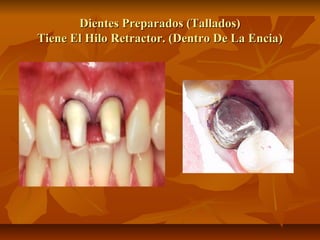 Dientes Preparados (Tallados)
Tiene El Hilo Retractor. (Dentro De La Encia)
 