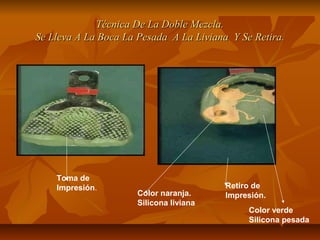 Técnica De La Doble Mezcla.
Se Lleva A La Boca La Pesada A La Liviana Y Se Retira.




    Toma de
    Impresión.                           Retiro de
                      Color naranja.     Impresión.
                      Silicona liviana
                                              Color verde
                                              Silicona pesada
 
