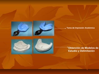 Toma de Impresión Anatómica




 Obtención de Modelos de
 Estudio y Delimitación
 
