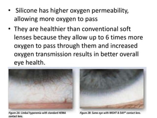• Silicone has higher oxygen permeability,
allowing more oxygen to pass
• They are healthier than conventional soft
lenses because they allow up to 6 times more
oxygen to pass through them and increased
oxygen transmission results in better overall
eye health.
 