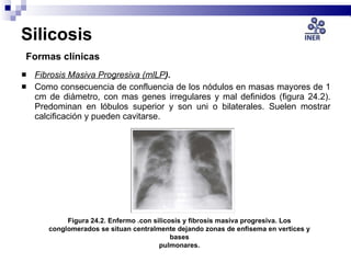 Silicosis   Formas clínicas <ul><li>Fibrosis Masiva Progresiva (mlLP ).  </li></ul><ul><li>Como consecuencia de confluenci...