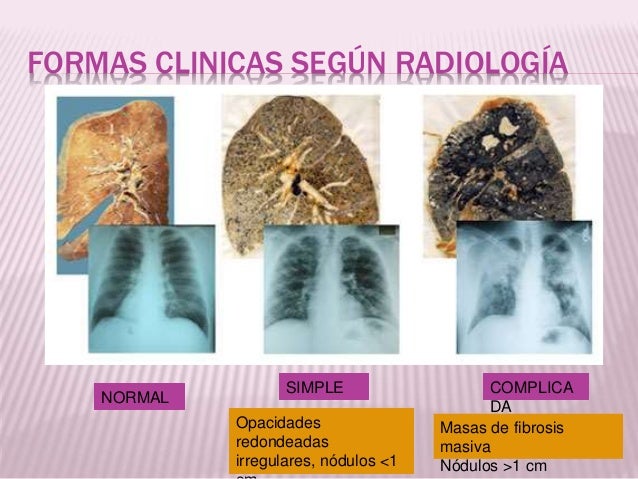 Silicosis