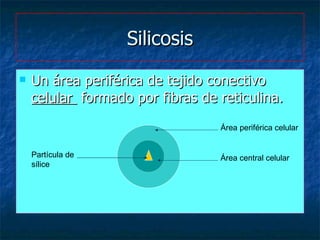 Silicosis <ul><li>Un área periférica de tejido conectivo  celular  formado por fibras de reticulina. </li></ul>Área perifé...