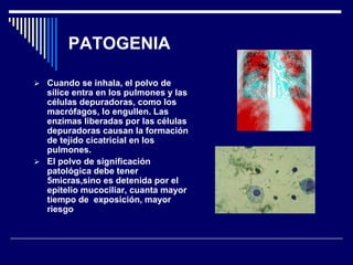 PATOGENIA
 Cuando se inhala, el polvo de
sílice entra en los pulmones y las
células depuradoras, como los
macrófagos, lo engullen. Las
enzimas liberadas por las células
depuradoras causan la formación
de tejido cicatricial en los
pulmones.
 El polvo de significación
patológica debe tener
5micras,sino es detenida por el
epitelio mucociliar, cuanta mayor
tiempo de exposición, mayor
riesgo
 