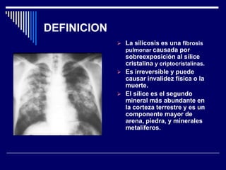 DEFINICION
 La silicosis es una fibrosis
pulmonar causada por
sobreexposición al sílice
cristalina y criptocristalinas.
...