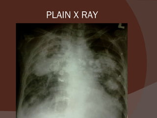 PLAIN X RAY 