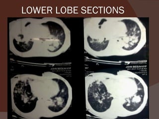 LOWER LOBE SECTIONS 