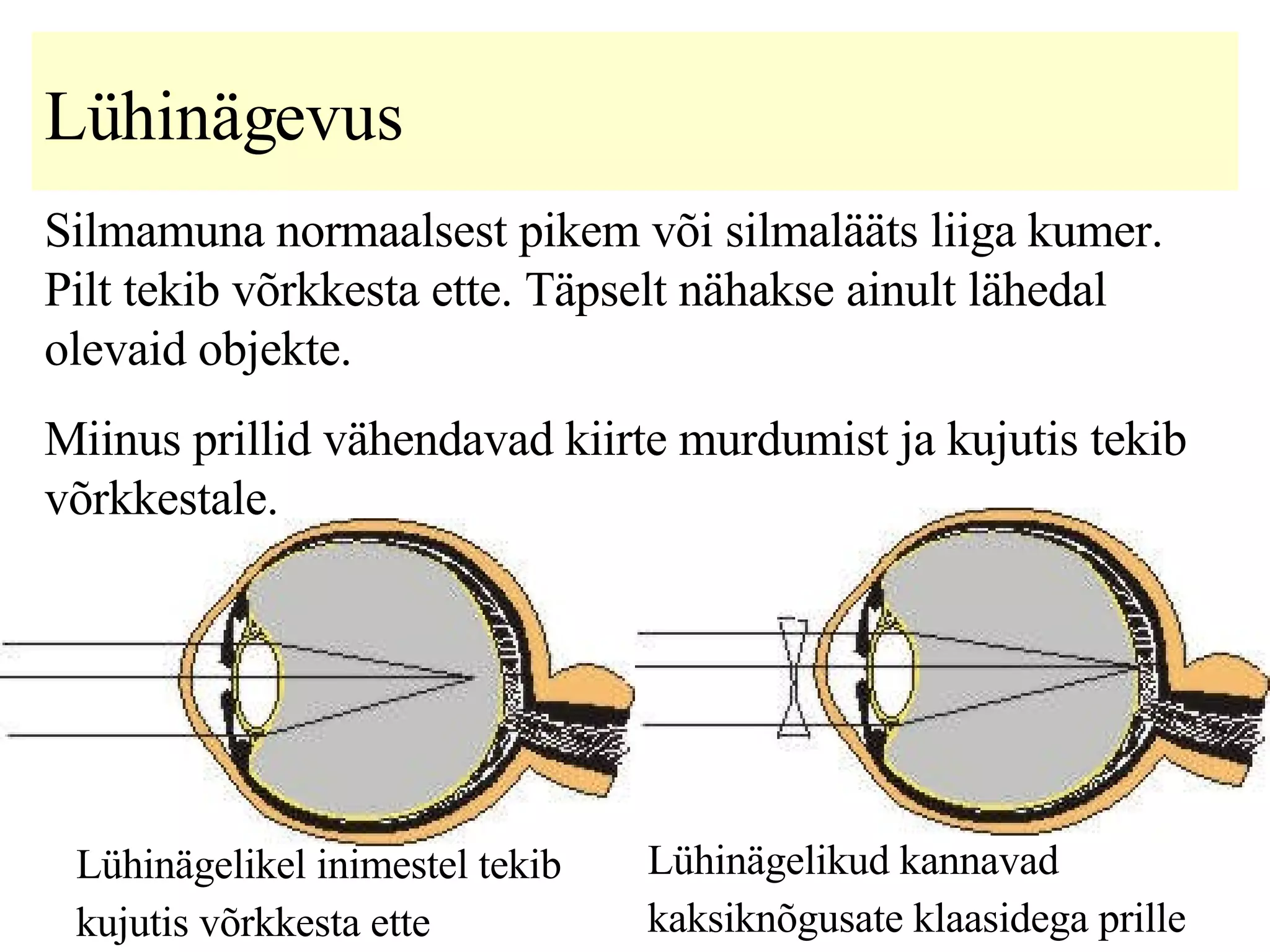 Lühinägevus S ilmamuna normaalsest pikem või silmalääts liiga kumer.   Pilt tekib võrkkesta ette.  Täpselt nähakse ainult lähedal olevaid objekte .   M iinus prill id  vähendavad kiirte murdumist ja kujutis tekib võrkkestale.   Lühinägelikel inimestel tekib kujutis võrkkesta ette   Lühinägelikud kannavad kaksiknõgusate klaasidega prille   