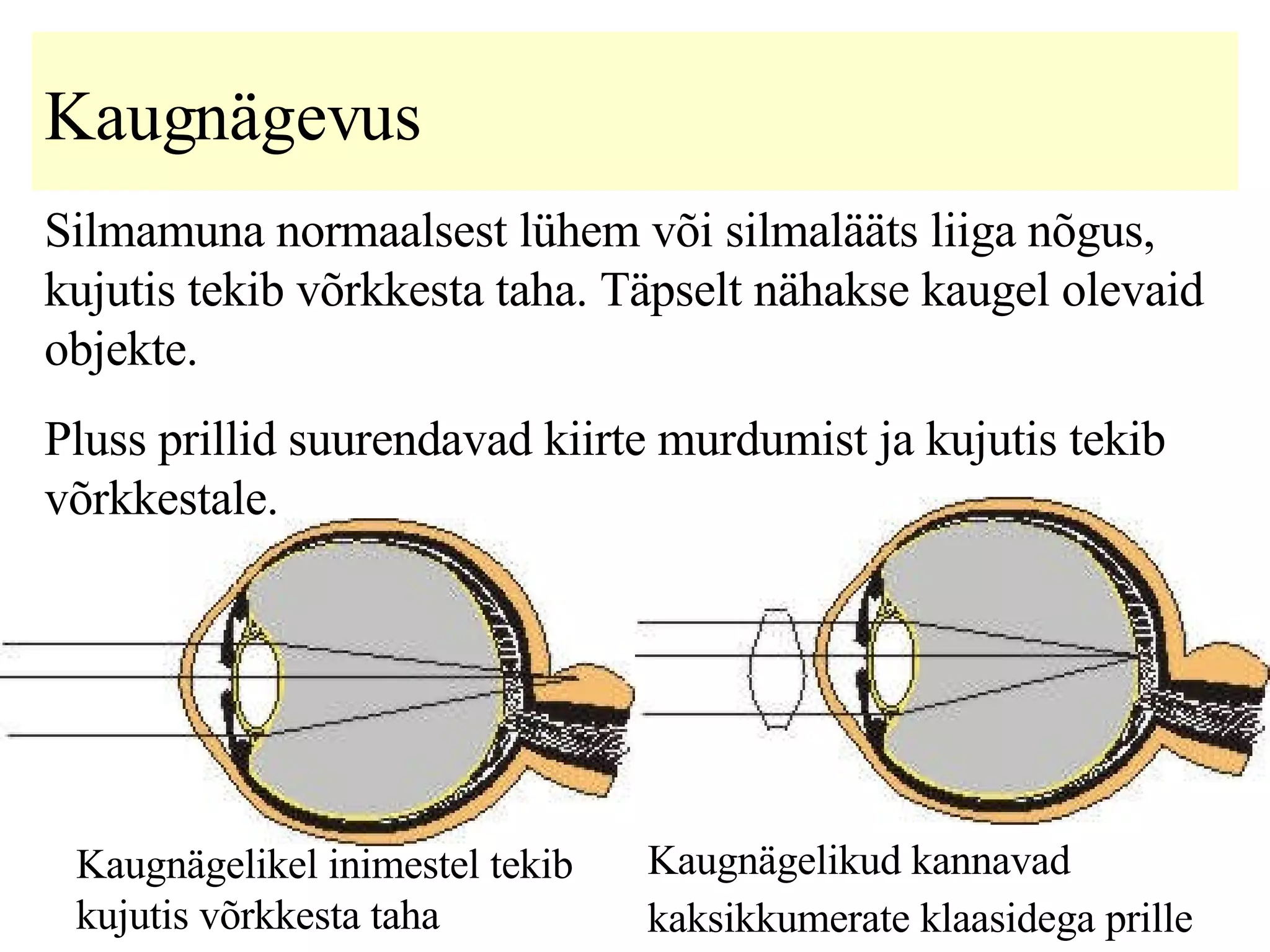 Kaugnägevus S ilmamuna normaalsest lühem või silmalääts liiga nõgus ,  kujutis   tekib võrkkesta taha.  Täpselt nähakse kaugel olevaid objekte.   Pluss  prill id   suurendavad  kiirte murdumist ja kujutis tekib võrkkestale.   Kaugnägelikel inimestel tekib kujutis võrkkesta taha   Kaugnägelikud kannavad kaksikkumerate klaasidega prille   
