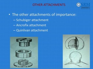 silo.tips_overdentures-presented-by-department-of-prosthodontics ...