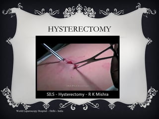 HYSTERECTOMY World Laparoscopy Hospital – Delhi - India 