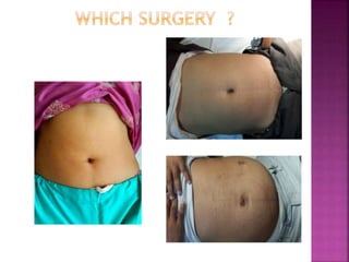 Single Incision Mus SILS - SINGLE INCISION LAPAROSCOPIC SURGERY | PPTX